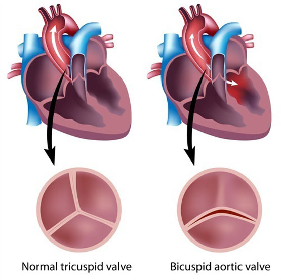 heart test palpitations valve babies Bicuspid children. aortic in Paediatric and